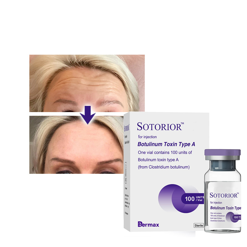 Sotorior Botulinum Toxin Type A